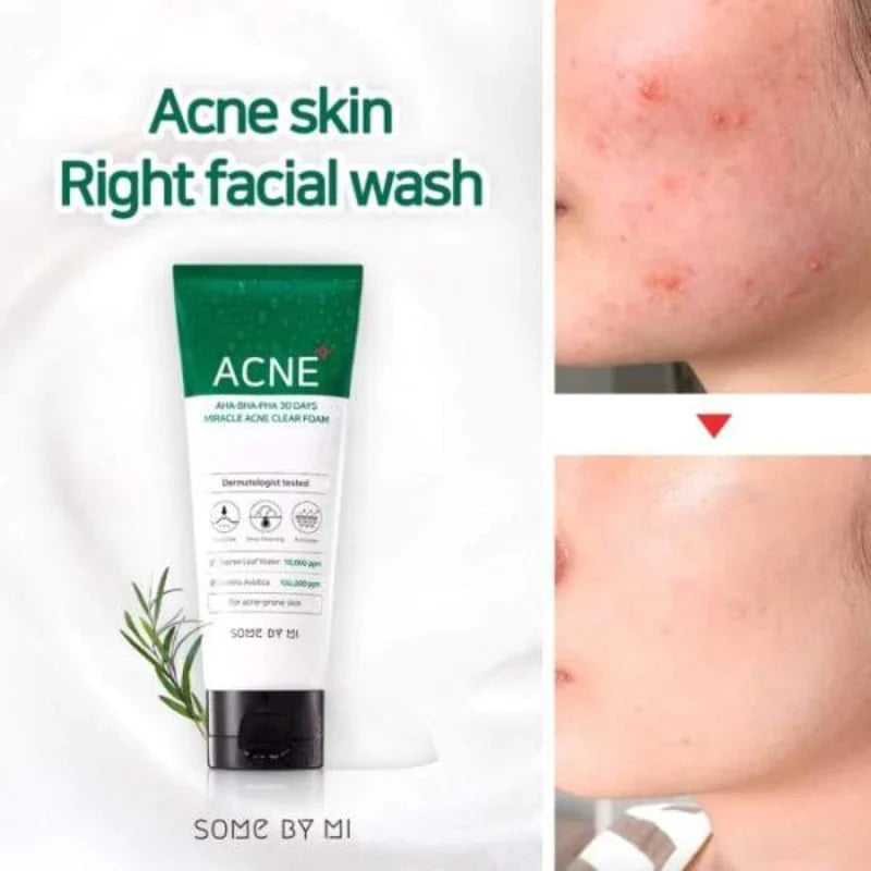 acne aha bha pha 30 days miracle acne clear foam